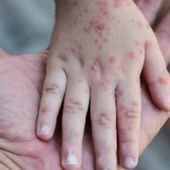 Атырауда жүздеген адамның қызылша жұқтырғаны хабарланды