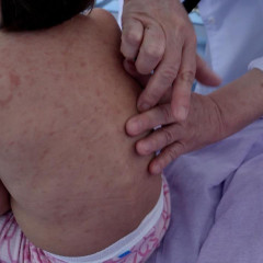 Қызылша жұқтырған балалар көбейген: Дәрігерлер ата-аналарға үндеу жасады